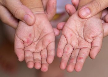 Persyaratan Daerah Tetapkan Keadaan Darurat Penyakit Menular