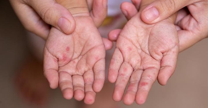 Persyaratan Daerah Tetapkan Keadaan Darurat Penyakit Menular