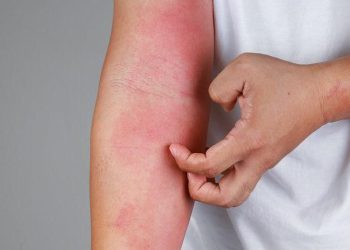Gejala Dermatitis Atopik pada Kulit Gelap yang Tidak Selalu Merah
