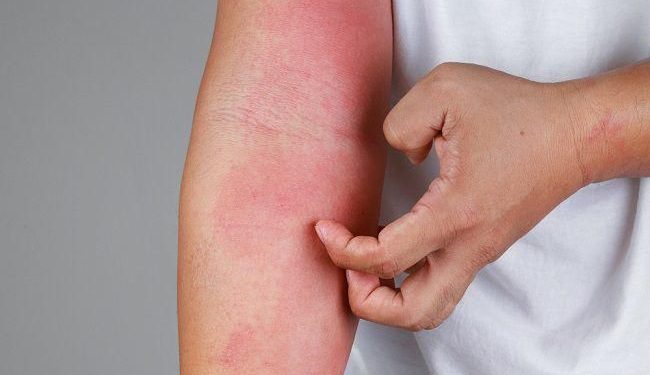 Gejala Dermatitis Atopik pada Kulit Gelap yang Tidak Selalu Merah