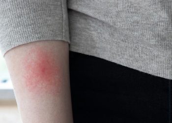 Dampak Berbahaya Lyme yang Tak Segera Diatasi