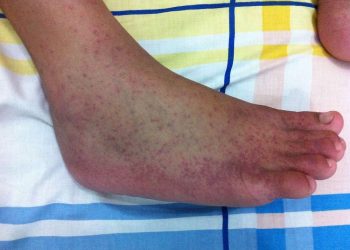 Waspada! Tanda-Tanda Chikungunya yang Sering Diabaikan