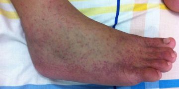 Waspada! Tanda-Tanda Chikungunya yang Sering Diabaikan