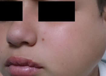 Apakah Gondongan Bisa Sembuh Sendiri?