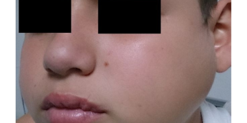 Apakah Gondongan Bisa Sembuh Sendiri?