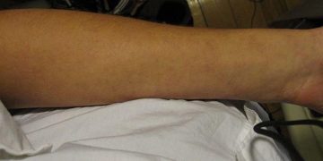 Perbedaan Bintik Merah DBD dan Biang Keringat, Jangan Salah!