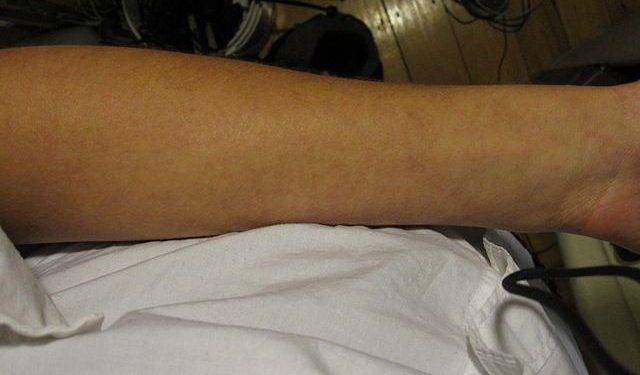 Perbedaan Bintik Merah DBD dan Biang Keringat, Jangan Salah!