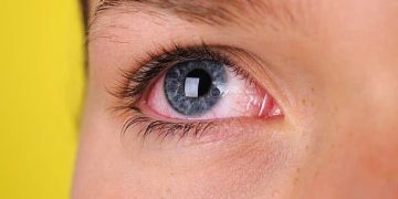 7 Penyebab Mata Merah, Apakah Wajar?